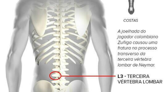 vertebra neymar