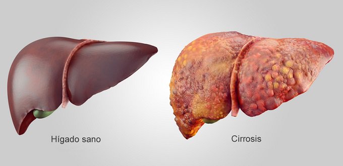 cirrosis-hepática