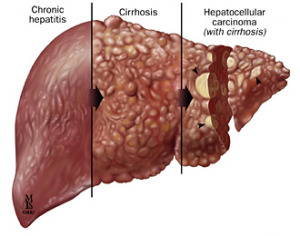 hepatitis