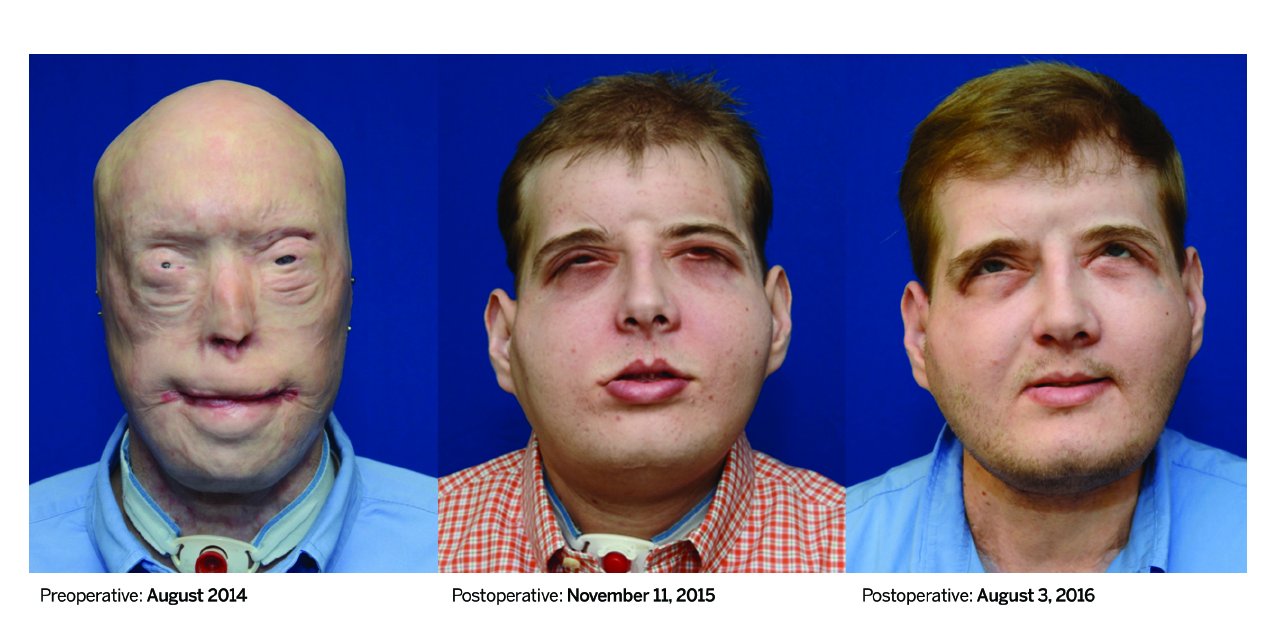 trasplante-cara-proceso