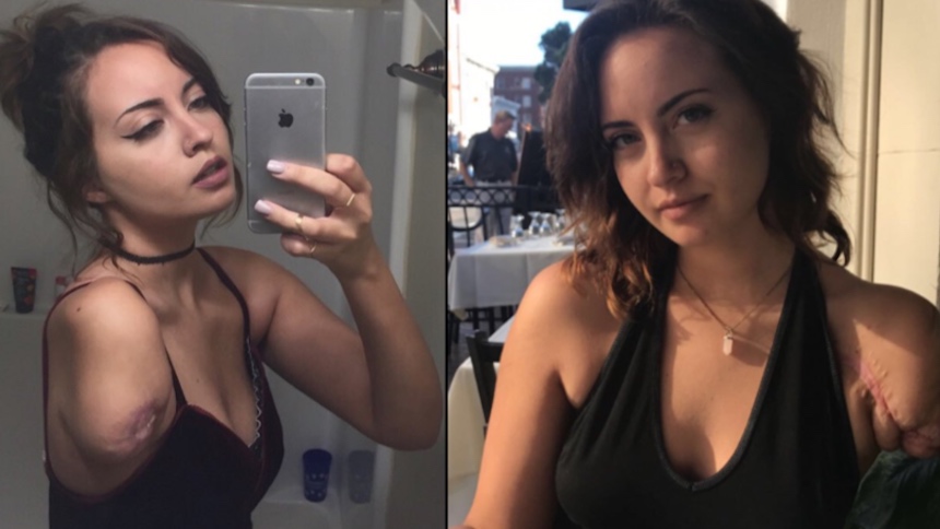 La chica con un brazo que se volvió sensación de Tinder