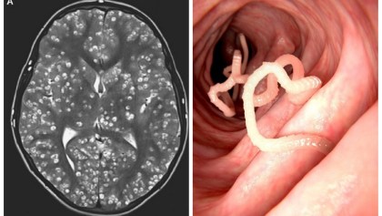 Gusanos habitando el cerebro de un paciente en la India