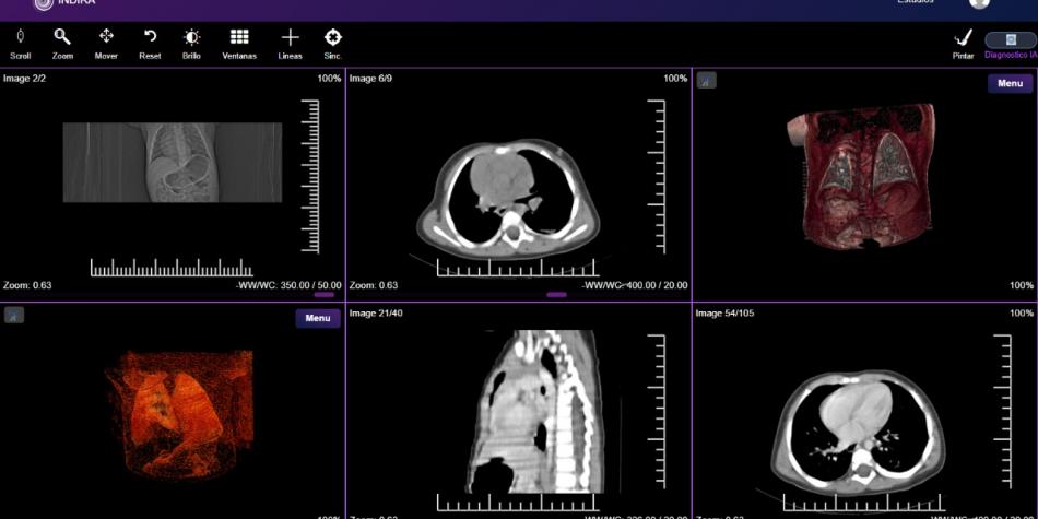 Una inteligencia artificial detecta el cáncer de pulmón con mayor precisión que los médicos 