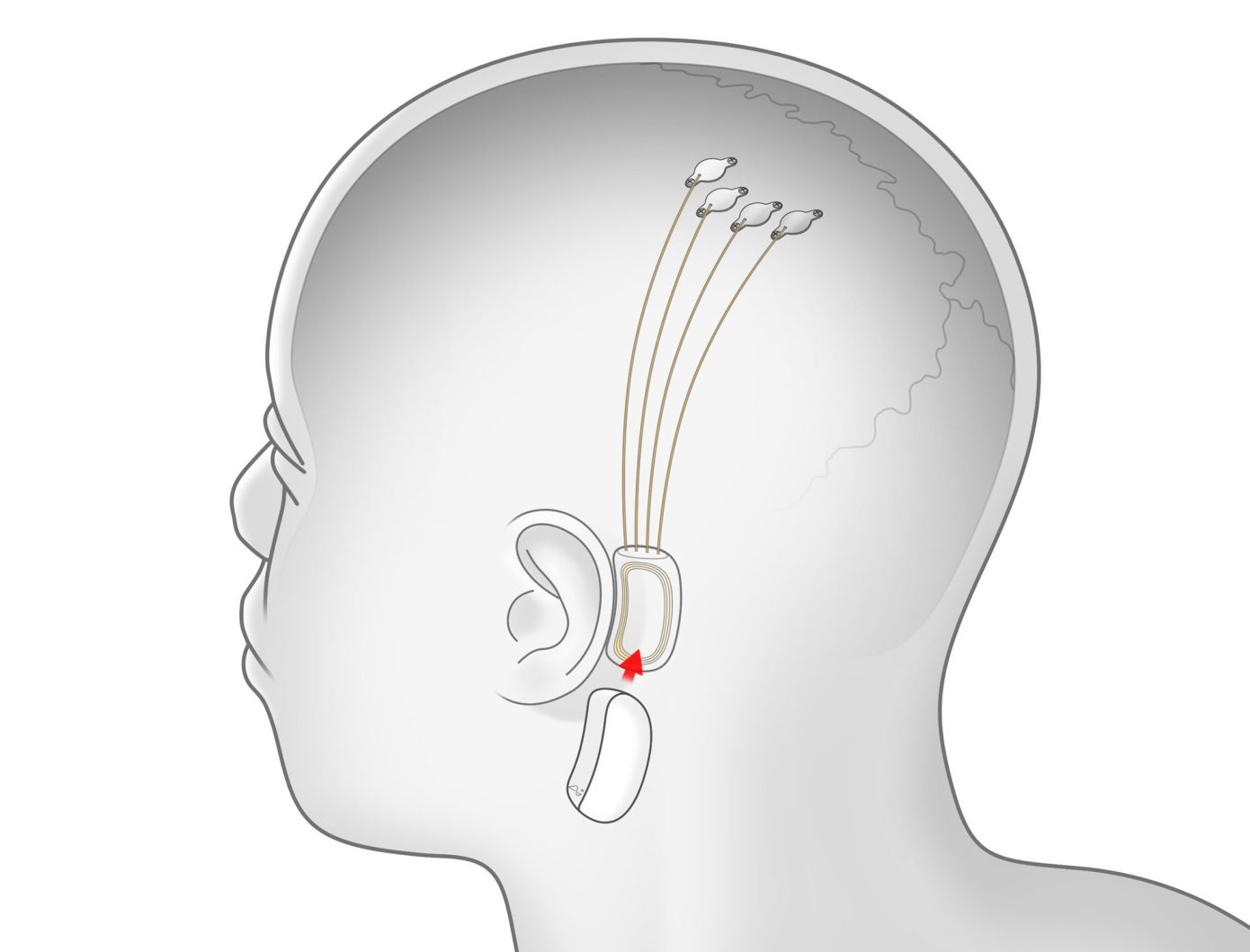 Elon Musk está trabajando en un chip cerebral para escuchar música