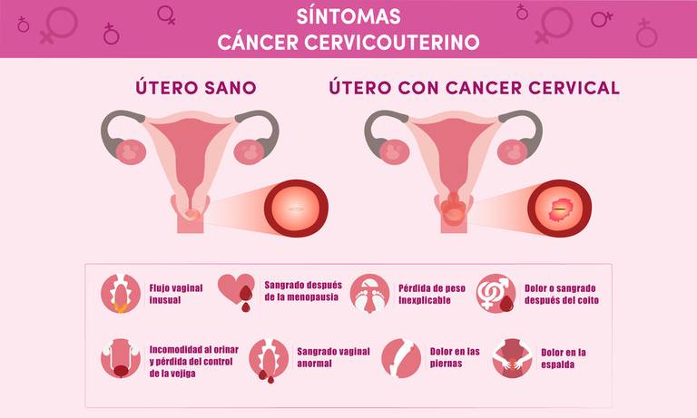 cancer-cerviouterino-sintomas