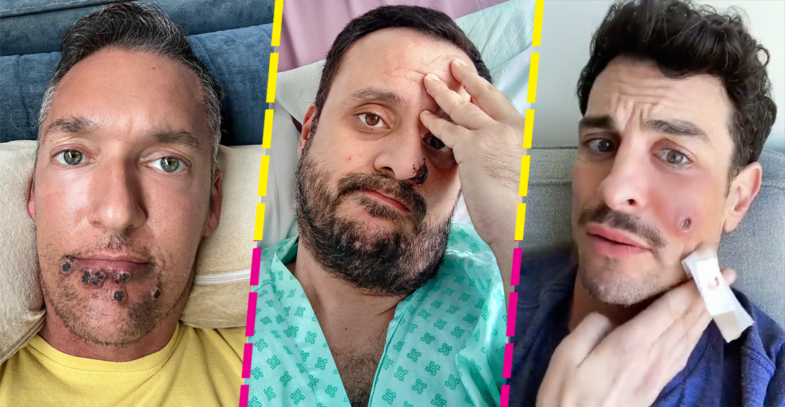 testimonios-caso-experiencia-viruela-simica-actor-del-mono-fiebre-dolor