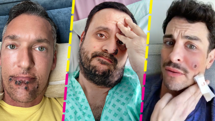 testimonios-caso-experiencia-viruela-simica-actor-del-mono-fiebre-dolor