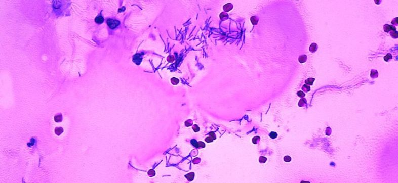 meningitis-casos-tamaulipas-estados-unidos