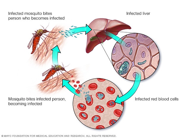 Alerta en Estados Unidos por casos de malaria: ¿cuáles son los síntomas y cómo prevenirla?