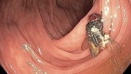 Encuentran mosca intacta en el colon de un hombre