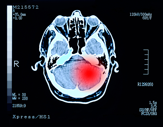 ‘Retreat’: El ensayo con medicamentos para el VIH para el tratamiento de tumores cerebrales