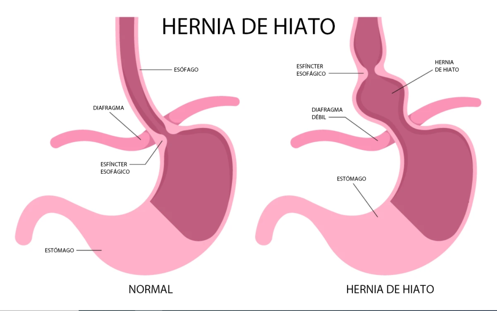 La hernia hiatal en el estómago