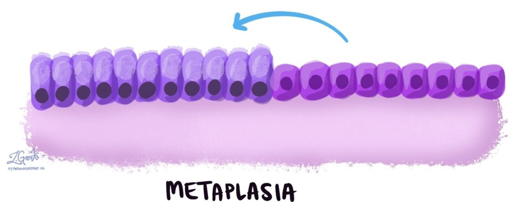 Lo que pasa con la metaplasia